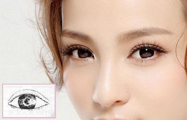 埋线双眼皮能保持几年 哪些人适合做埋线双眼皮手术