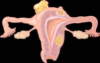 怎么判断恶性子宫肌瘤 恶性子宫肌瘤症状有哪些