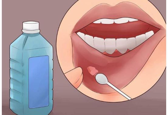 口腔溃疡是什么原因导致的？口腔溃疡吃什么好的快？