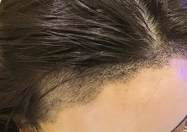 种植头发要多长时间 种植头发步骤有哪些