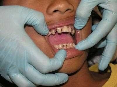 牙龈溃烂中医治疗方法 牙龈
