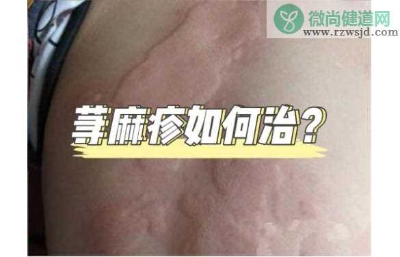 患荨麻疹怎么治疗？荨麻疹反复