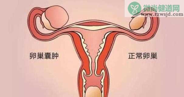 卵巢囊肿是怎么造成的 卵巢囊肿会癌变吗