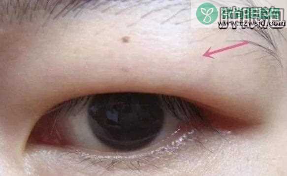 肿眼泡是什么原因造成的 眼