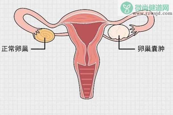 卵巢囊肿怎么治疗 右下腹痛是卵巢囊肿吗