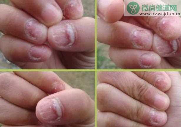 哺乳期灰指甲会传染宝宝吗 灰指甲的传染途径有哪些