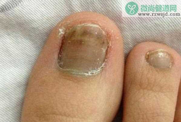 灰指甲前期有哪些症状 钩甲肥厚甲面凹凸不平分离变