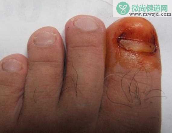 穿灰指甲患者的拖鞋会传染吗 真菌病传染源避免同用