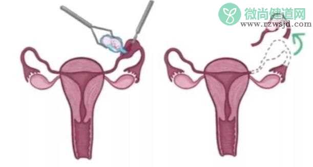 为什么输卵管切除后会怀孕 