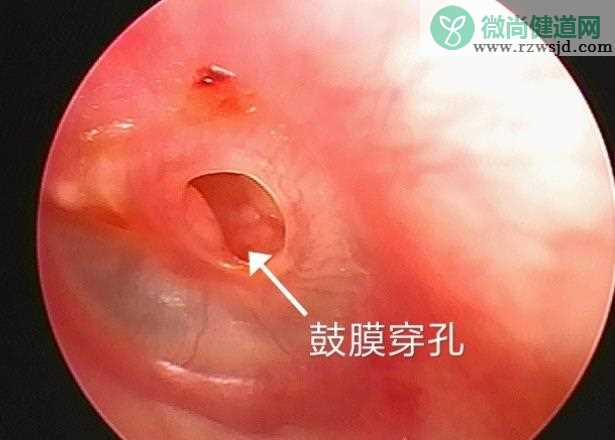 鼓膜穿孔修复手术多少钱 鼓膜穿孔怎么治疗