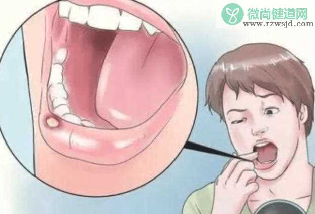 口腔溃疡是哪些因素引起的 免疫力低下缺乏营养素重