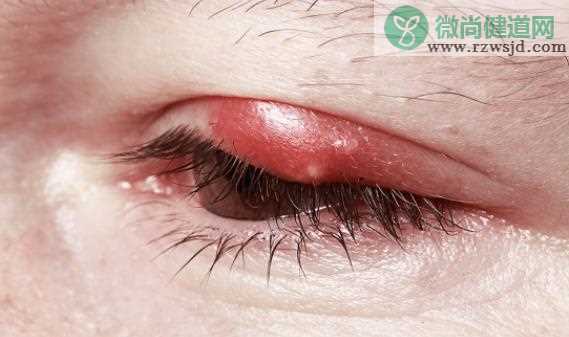 引起麦粒肿的原因有哪些 上火用眼不卫生眼部炎症