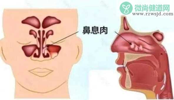 西医如何治疗鼻息肉 鼻息肉