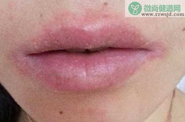 唇炎的症状有哪些 口唇干燥