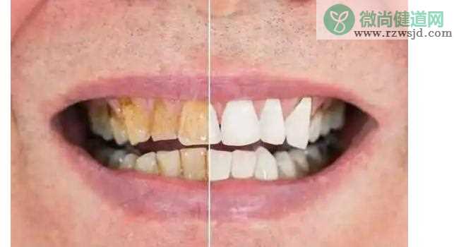 牙齿有黄斑怎么去除呢？如何避