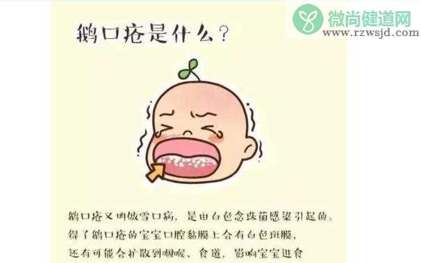 鹅口疮危害大吗？宝宝鹅口疮应