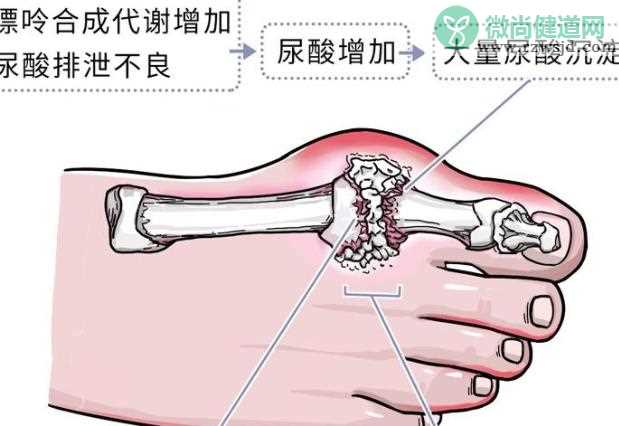 尿酸500多算高吗 尿酸高的原