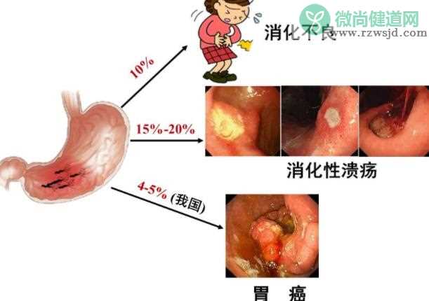 感染幽门螺杆菌有哪些症状 