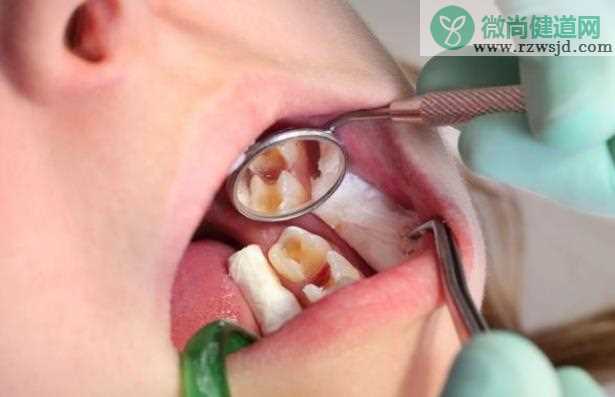 如何预防蛀牙 蛀牙怎么治疗