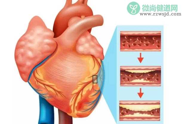 冠心病是心脏病吗？冠心病是传