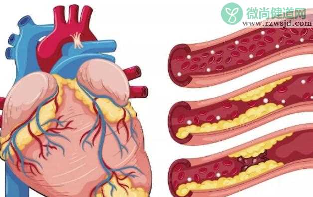 冠心病预防与保健 ？冠心病的分类？