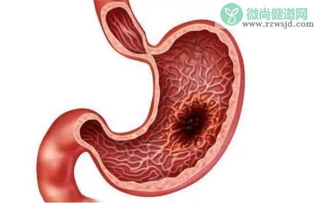 利于急性肠胃炎恢复的食物有哪些 ？肠胃炎是什么？