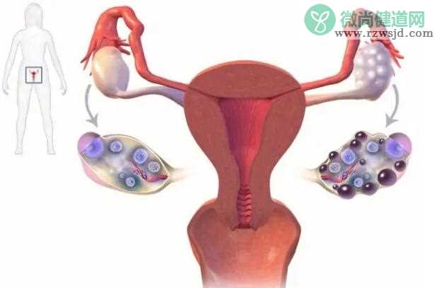 多囊性卵巢的治疗方法？多囊要