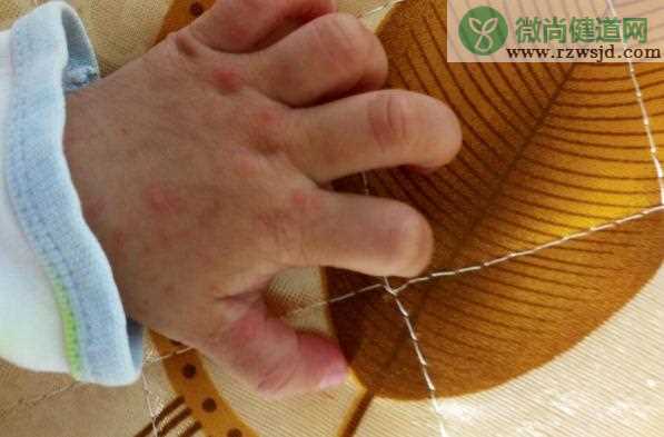 手足口病如何护理？水痘和手足口病的区别？