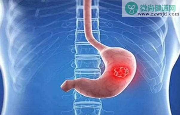 胃癌晚期能活多久？胃癌晚期症状及其表现？