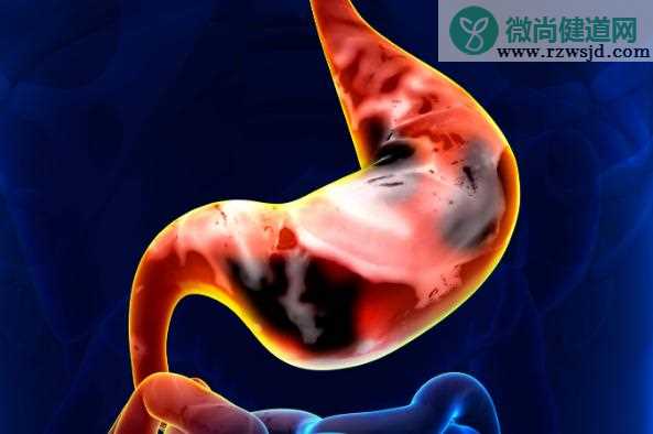 女性长期涂口红易诱发胃癌？胃癌如何检查出来的？