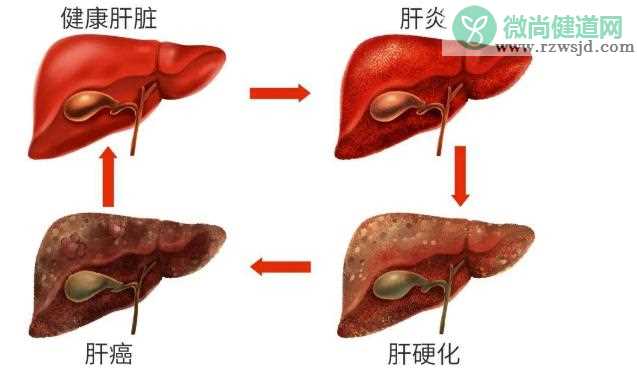 酒精肝如何治疗？酒精肝会腹泻