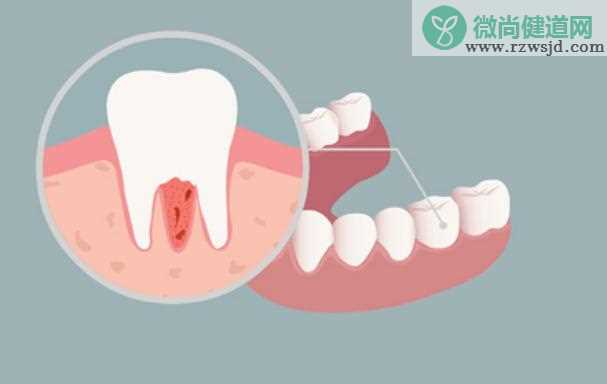 牙周炎怎么预防？牙周炎有什么特征？