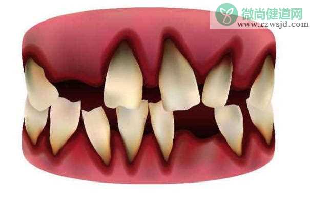 牙周炎治疗原则？牙周炎怎么诊断？