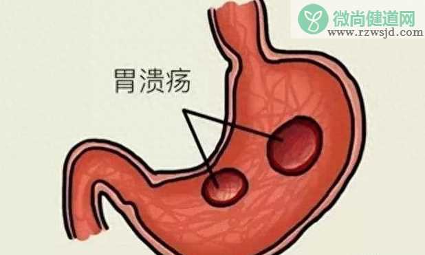 胃溃疡会造成幽门梗阻吗 胃溃疡严重了会怎样