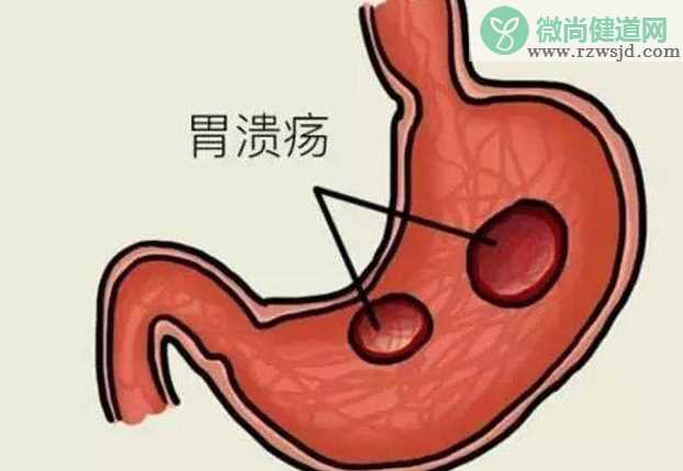 胃溃疡能癌变吗 胃溃疡恶变