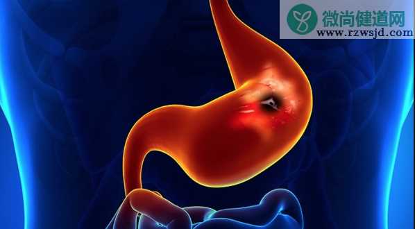 胃溃疡早期有哪些症状 得了