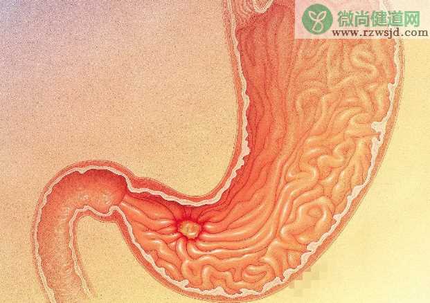 胃溃疡病变需要手术吗 胃溃