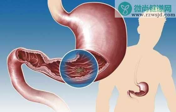 胃溃疡会遗传吗 胃溃疡不治