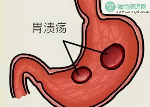 复合型胃溃疡会癌变吗 胃溃