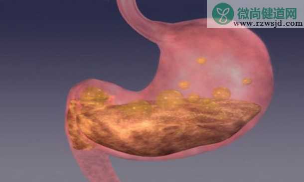 胃溃疡a1期会癌变吗 胃溃疡癌变的几率大吗
