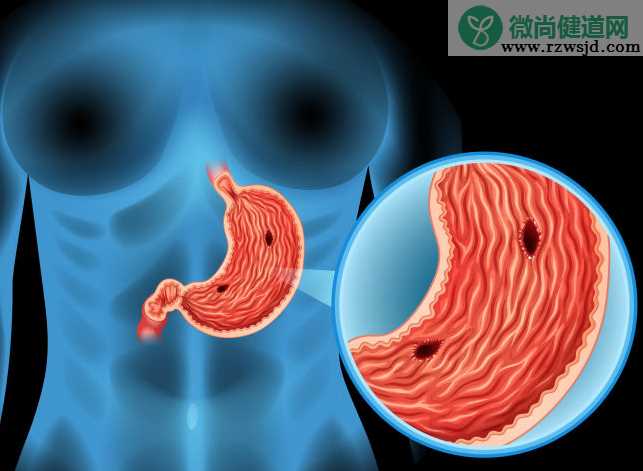 胃溃疡可以抽烟吗 影响胃壁细胞血液供应