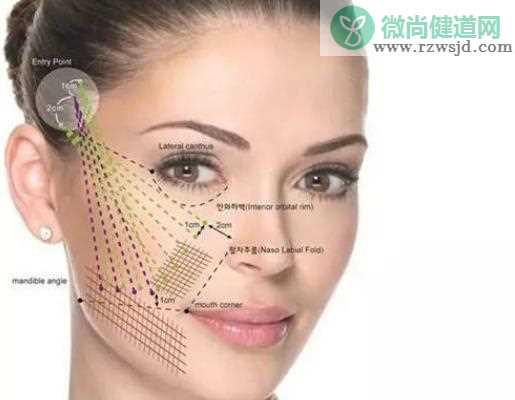 面部线雕提升可以维持多久 线雕的恢复期多长