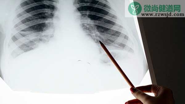 51岁女子硬扛流感10天 医生：两个肺都白了
