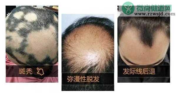 有疤痕的地方可以植发吗 脂溢性脱发可以植发吗