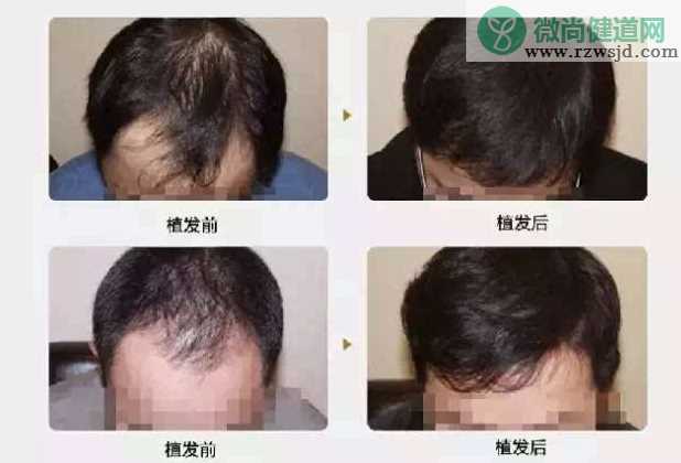 植发对人体有害吗 植发对头皮有伤害吗