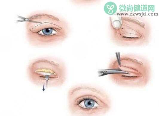双眼皮手术多久可以洗脸 做双眼皮过敏了怎么办