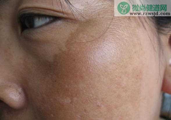 脸上的斑越来越多怎么回事 暴晒荷尔蒙变化年龄增长