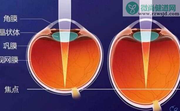 近视眼手术能恢复多少 近视