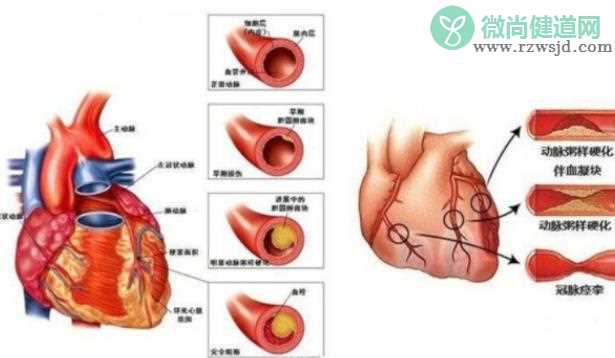 如何诊断冠心病 冠心病好了