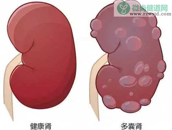 多囊肾病人能喝茶叶吗 多囊